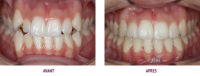 réalignement des dents avant-après